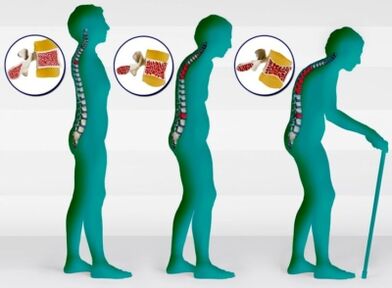 Osteoporoză